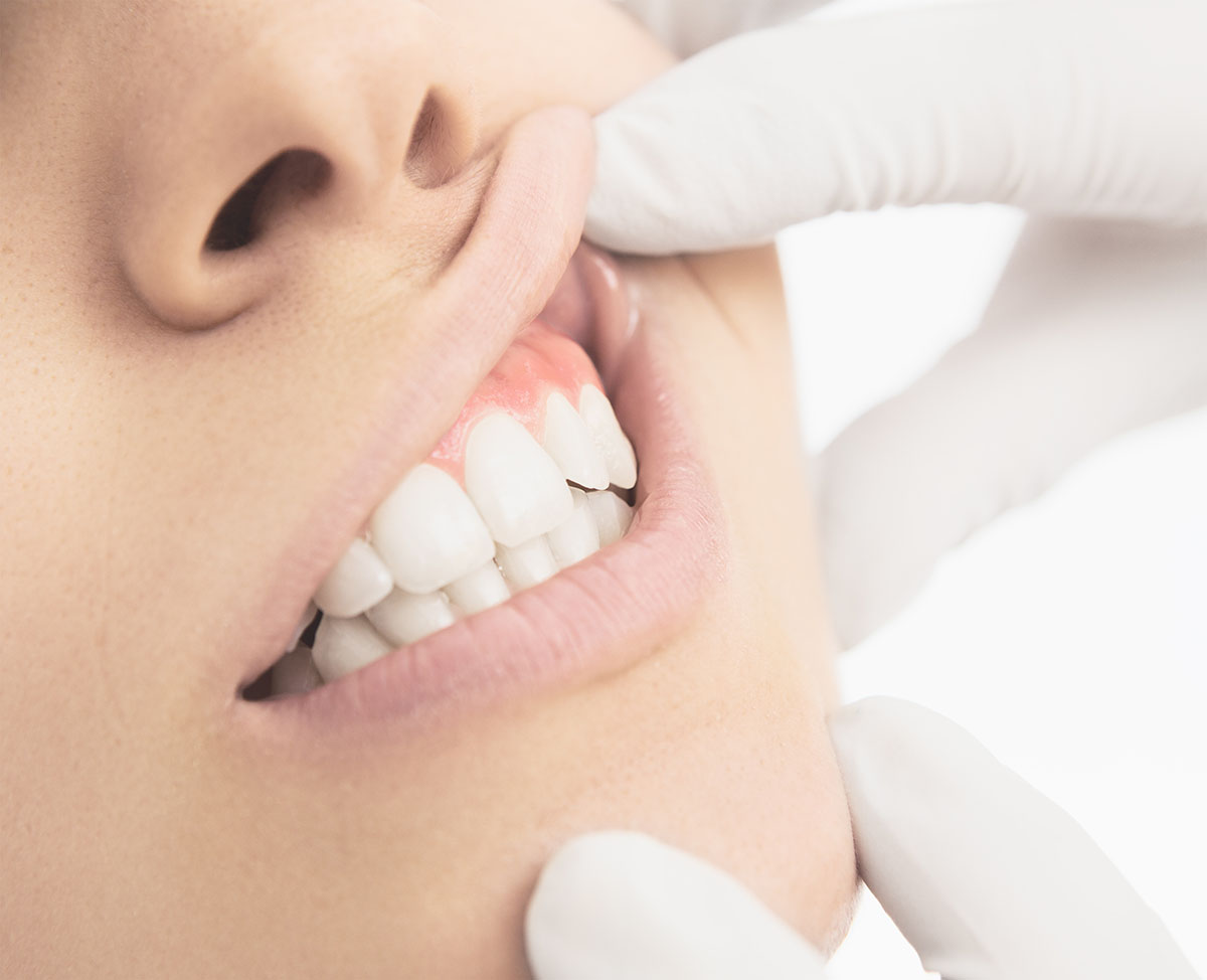 a doctor checking on a patients gums after she asked What is gingivitis