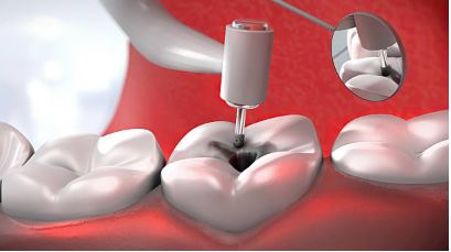 composite fillings