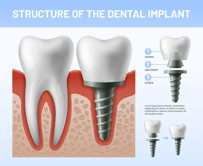 Dental Treatment Options to Repair a Cracked Tooth - Lasting Impressions  Dental Group Houston TX