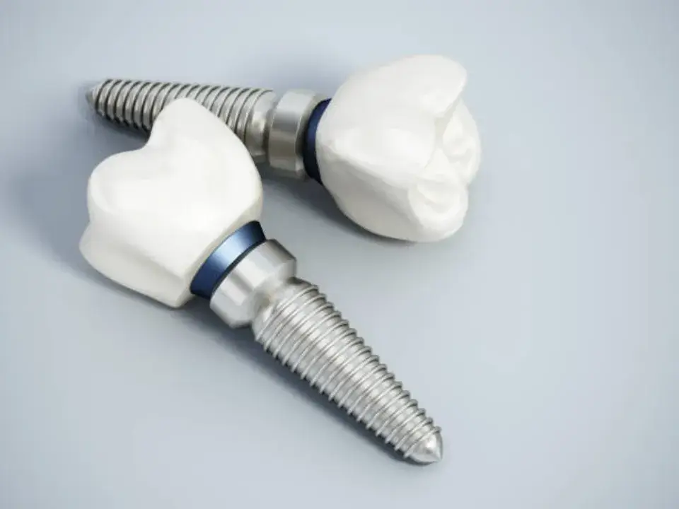 dental implants