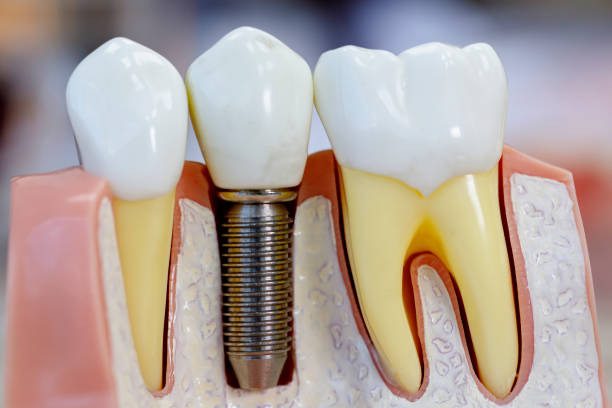 a dental model showing what dental implants looks like 