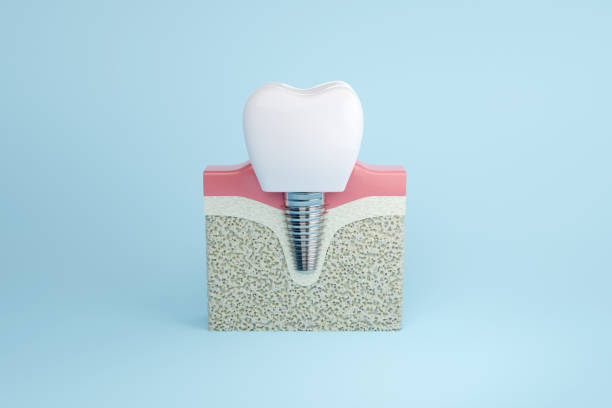 an image showing what a dental implant looks like once installed