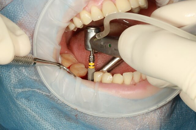 an image showing the installation of a dental implants