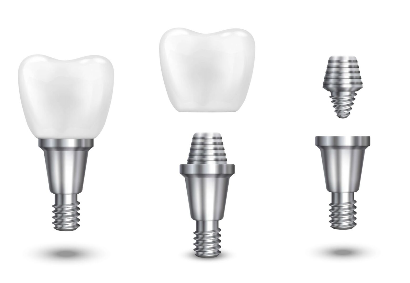 3D illustration of the different parts of a dental implant