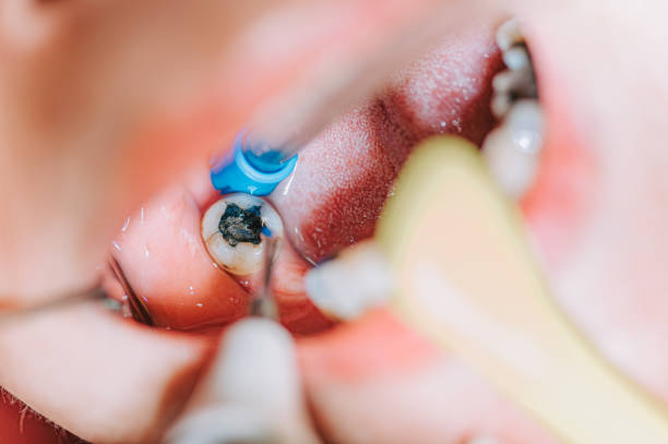 image showing a tooth with deep cavity getting treated