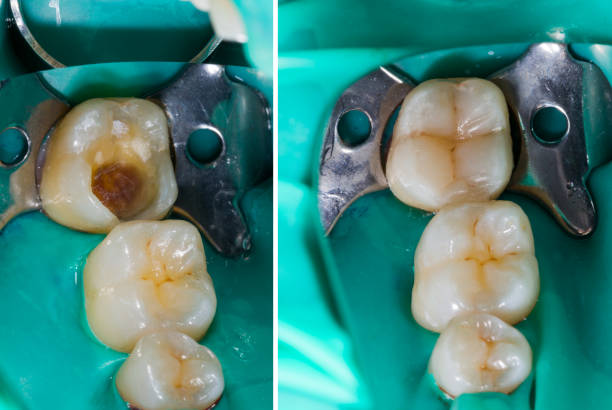 a comparison of tooth colored fillings before and after