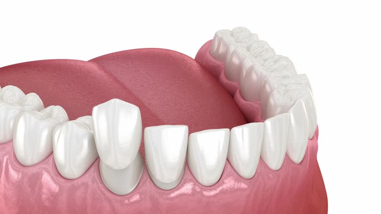 a photo showing a tooth with dental veneers