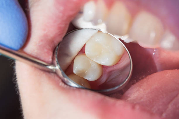 inspection of tooth colored fillings through a dental mirror