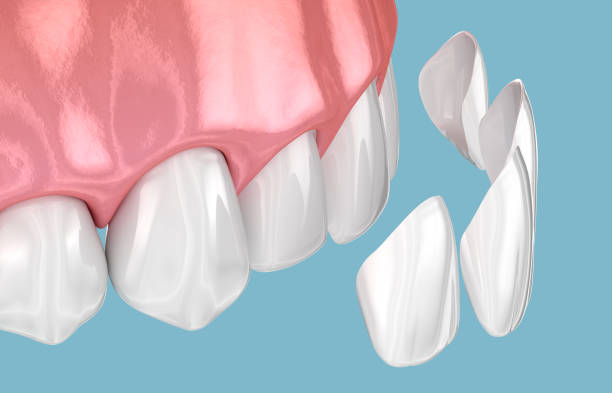 a digital image of a teeth showing how veneers are attached
