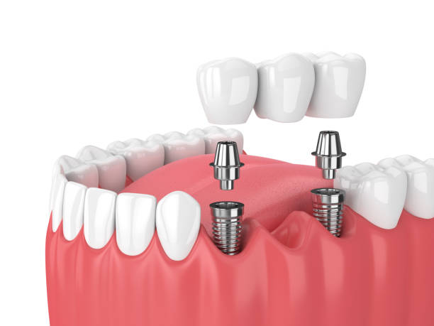 dental implants supported bridge