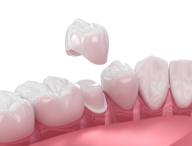 image showing how a dental bridge is installed