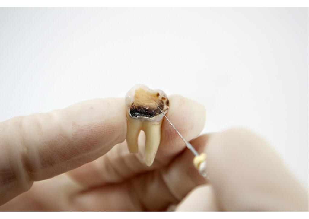 Close-up of a decayed dead tooth being examined during dental treatment