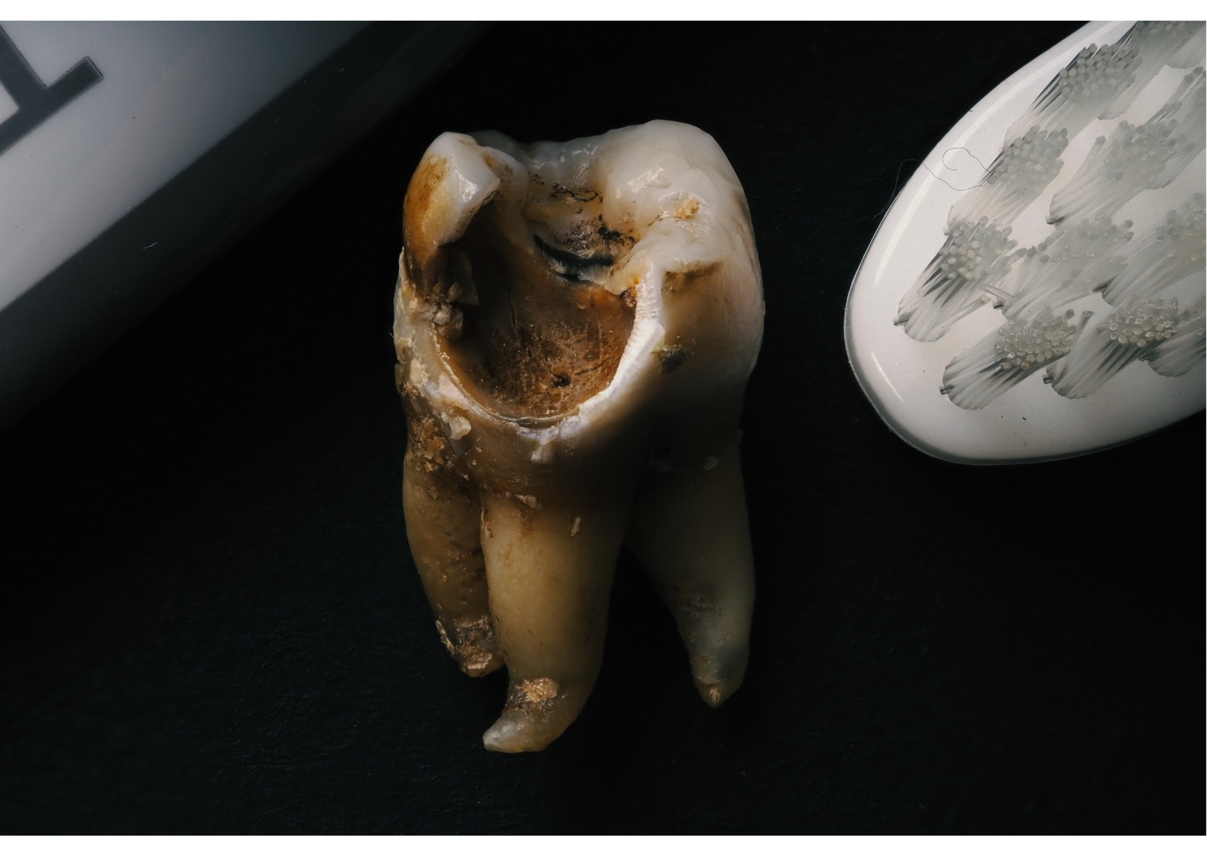 Severely decayed tooth with visible cavities and enamel damage beside a toothbrush