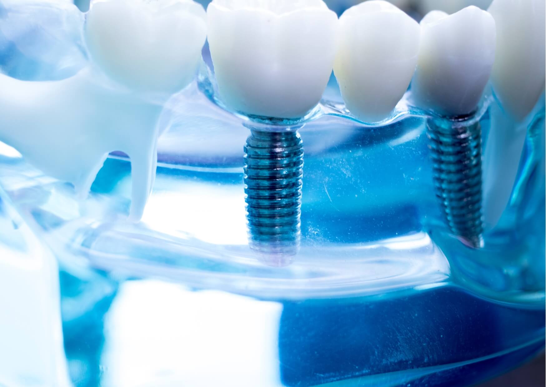 Close-up model of dental implants supporting replacement teeth, illustrating the stages involved in how long a tooth implant takes from placement to final restoration.