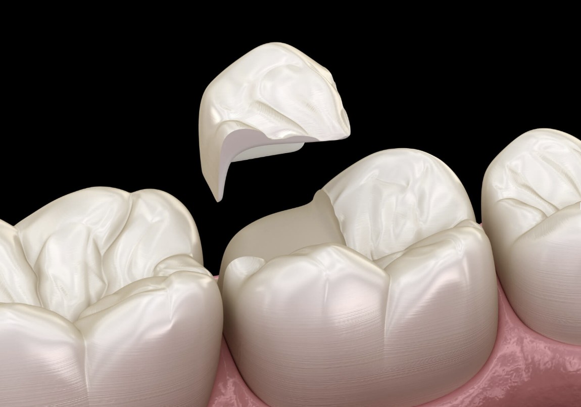 cracked tooth
