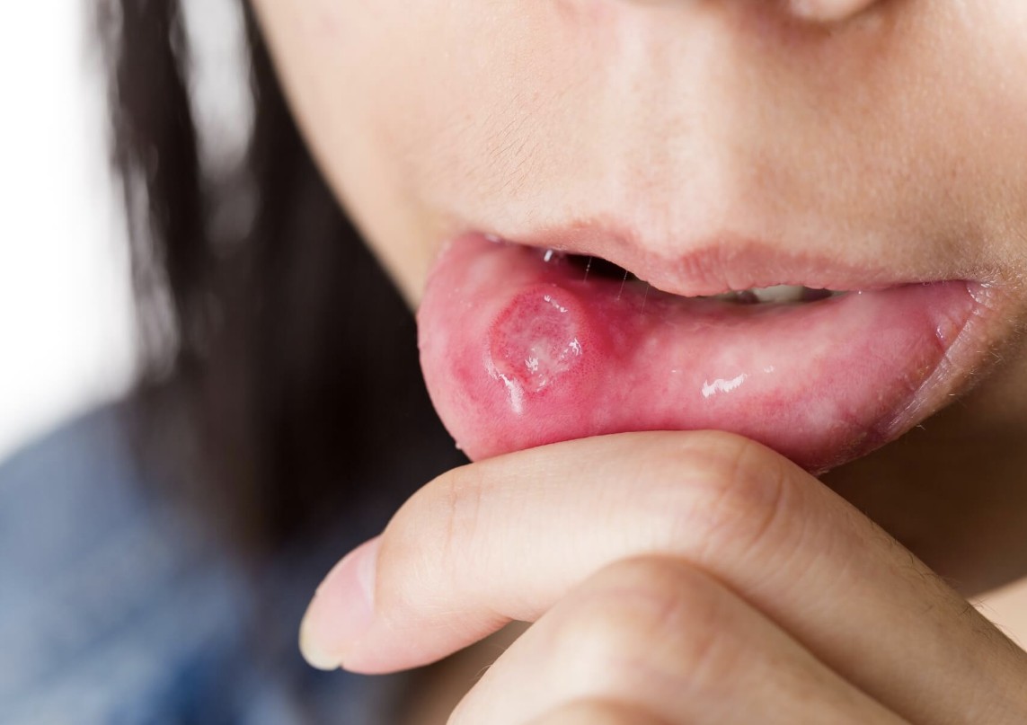cancer sores timeline
