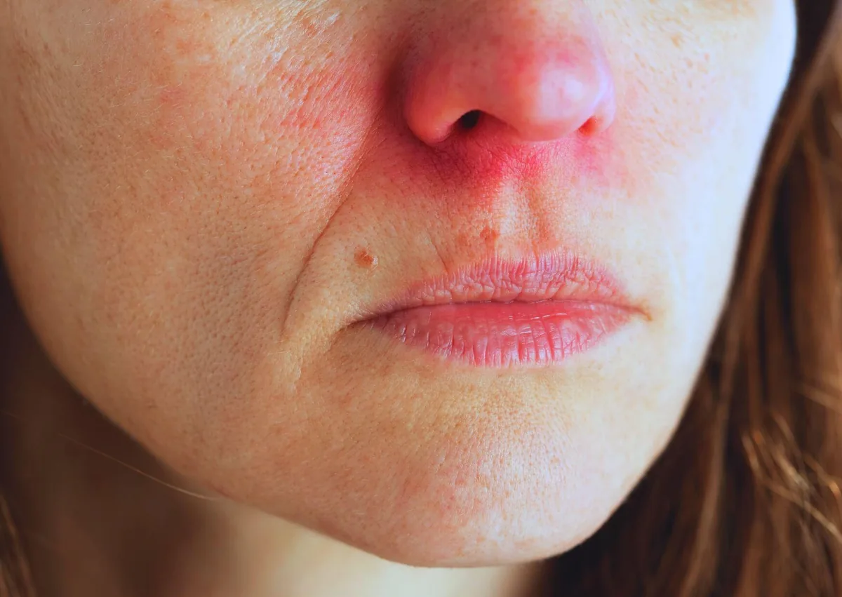 Close-up of dry, irritated lips and mouth associated with persistent dry mouth.
