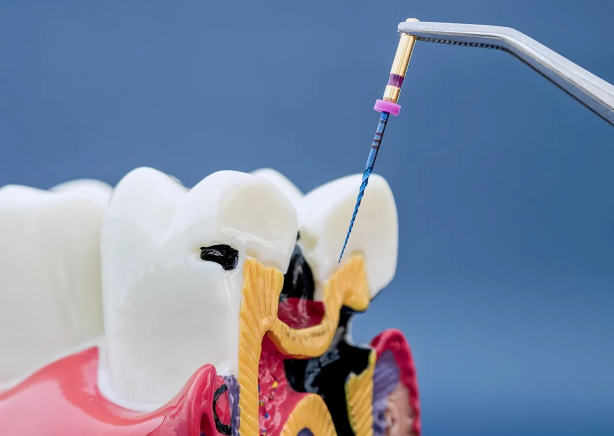 Root canal treatment model showing an endodontic file used to clean an infected tooth before crown placement.